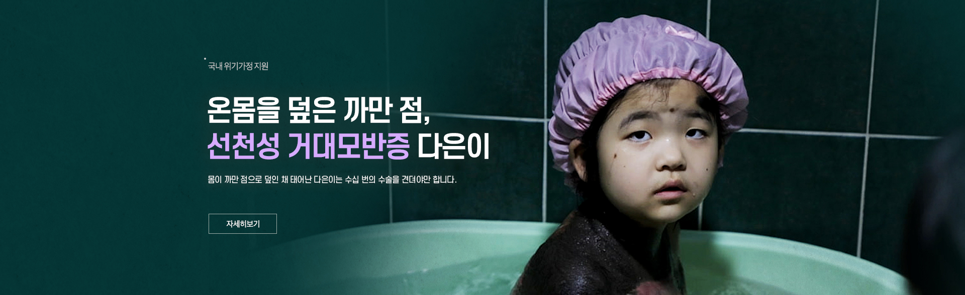 온몸을 덮은 까만 점, 거대모반증 다은