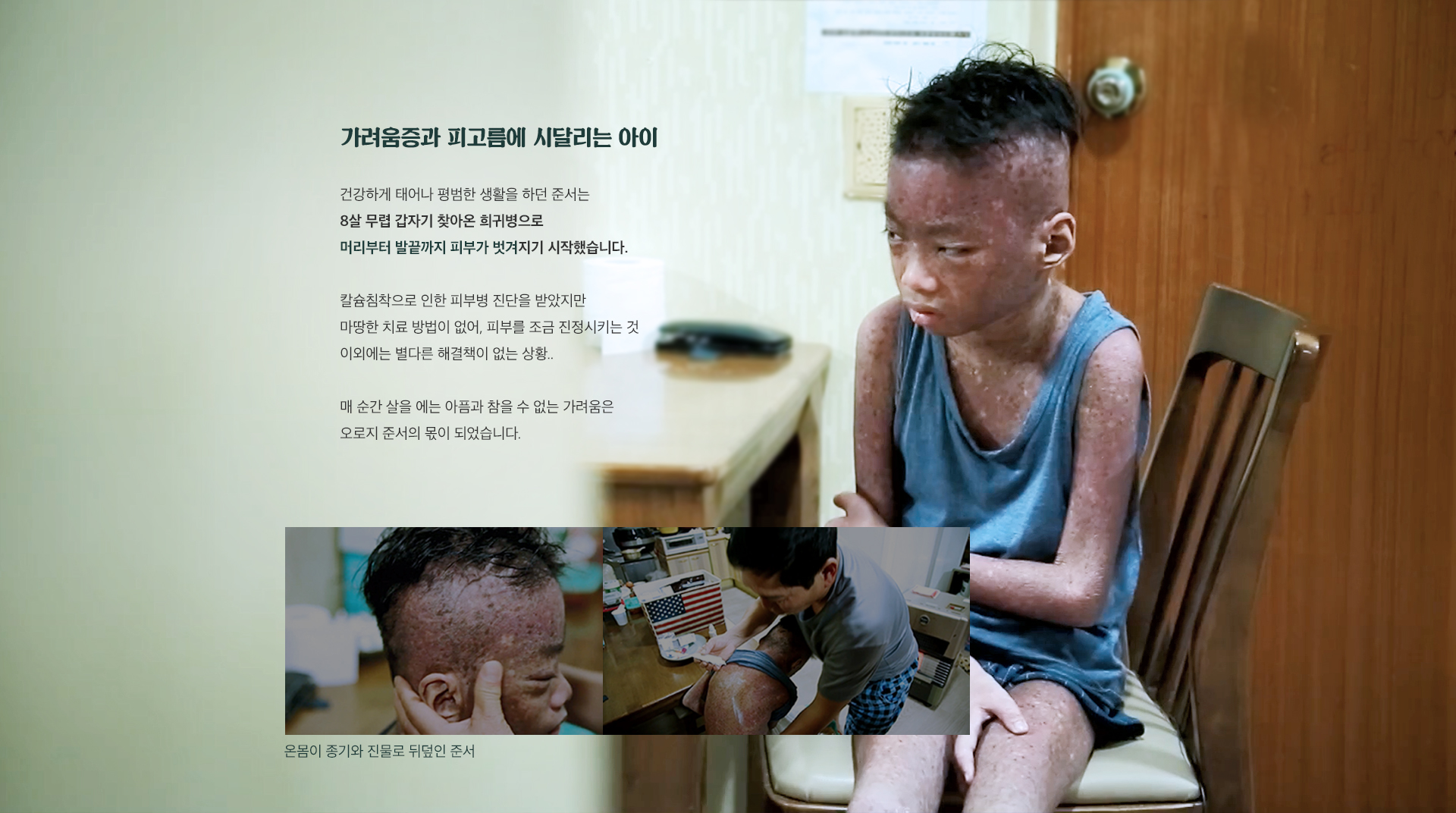 가려움증과 피고름에 시달리는 아이. 건강하게 태어나 평범한 생활을 하던 준서는 8살 무렵 갑자기 찾아온 희귀병으로 머리부터 발끝까지 피부가 벗겨지기 시작했습니다.