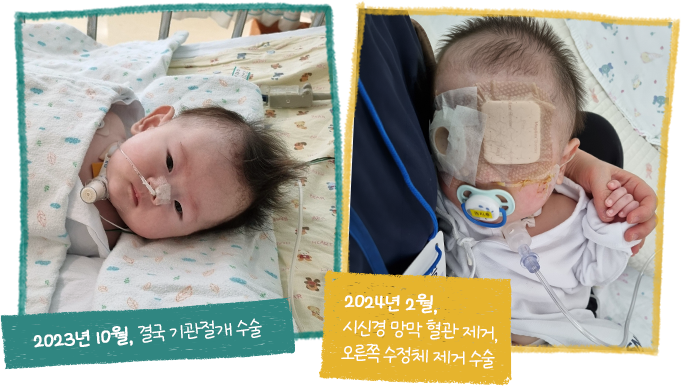 2023.10 결국 기관절개 수술, 2024.02 시신경 망막 혈관 제거오른쪽 수정체 제거 수술
